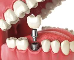 Impianti dentali