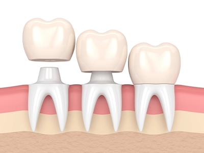 Faccette dentali
