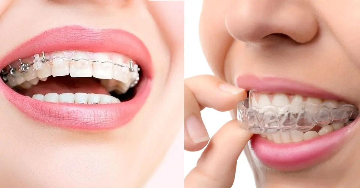 Ortodonzia e Invisalign
